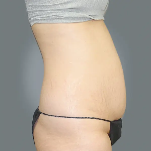 Before abdominoplasty left side view