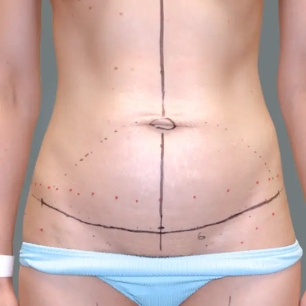 Before Abdominoplasty front view