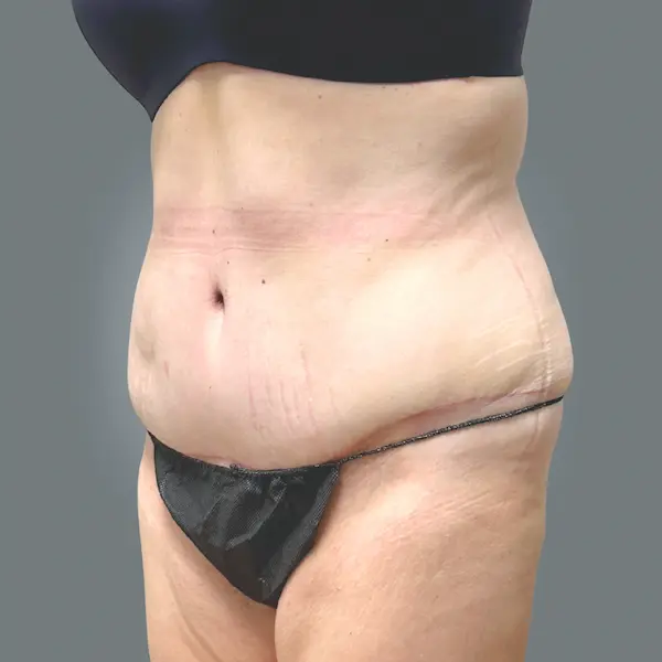 After abdominoplasty right oblique view