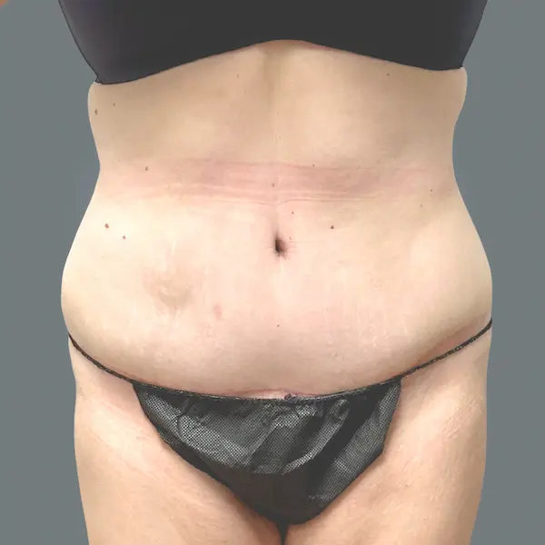 After abdominoplasty front view