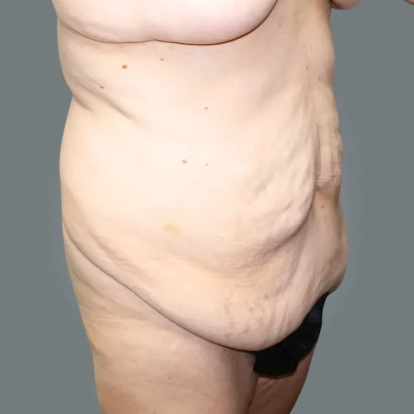 Before abdominoplasty left oblique view