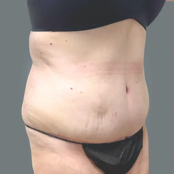 After abdominoplasty left oblique view