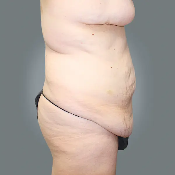 Before abdominoplasty left side view