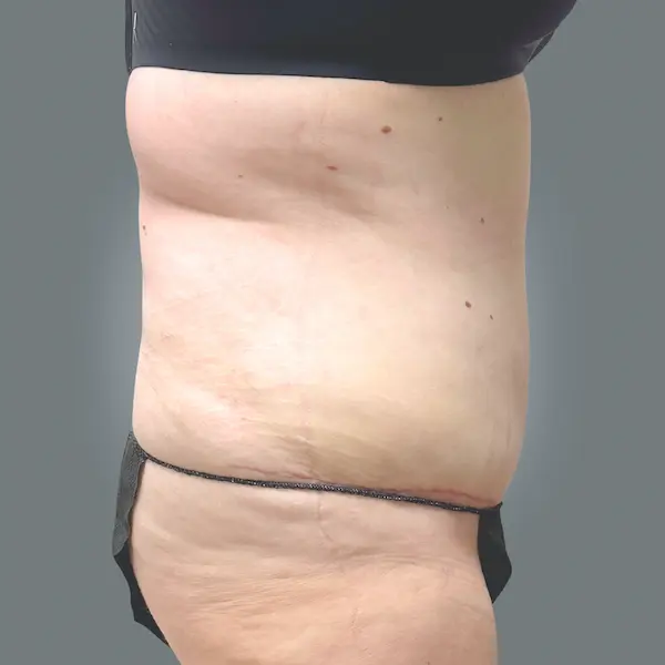 After abdominoplasty left side view