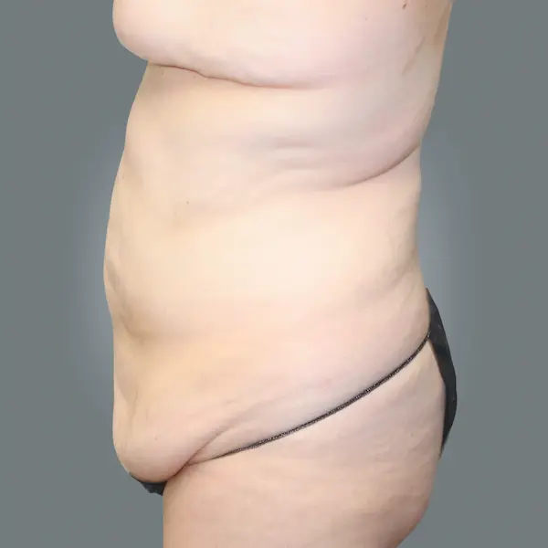 Before abdominoplasty right side view