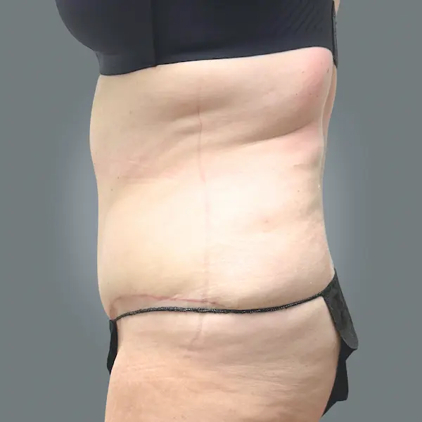 After abdominoplasty right side view