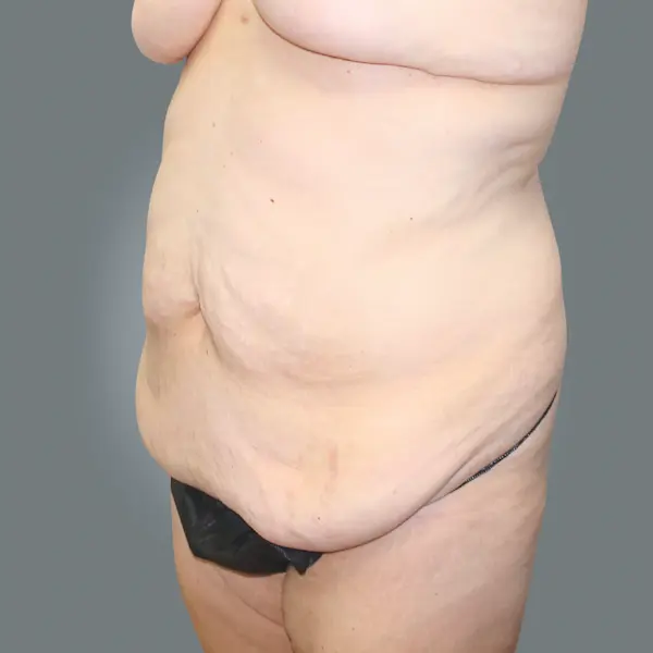 Before abdominoplasty right oblique view