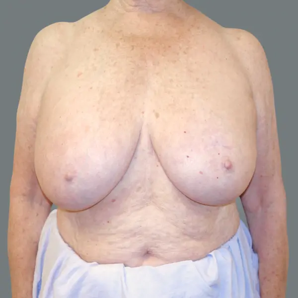 Before breast implant removal front view