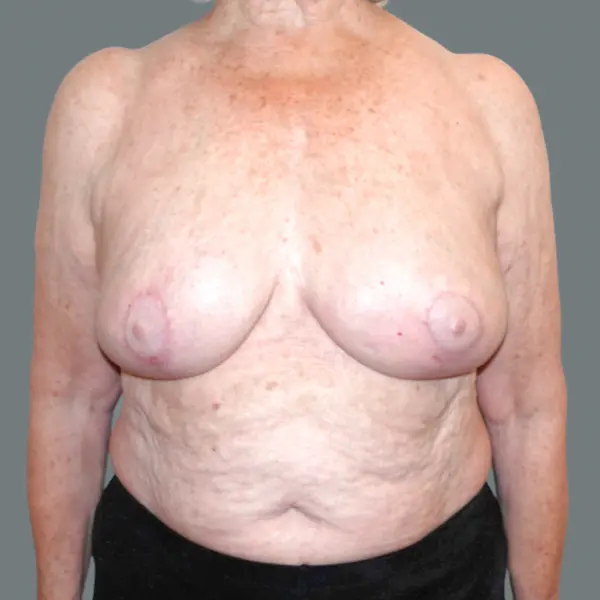 After breast implant removal front view