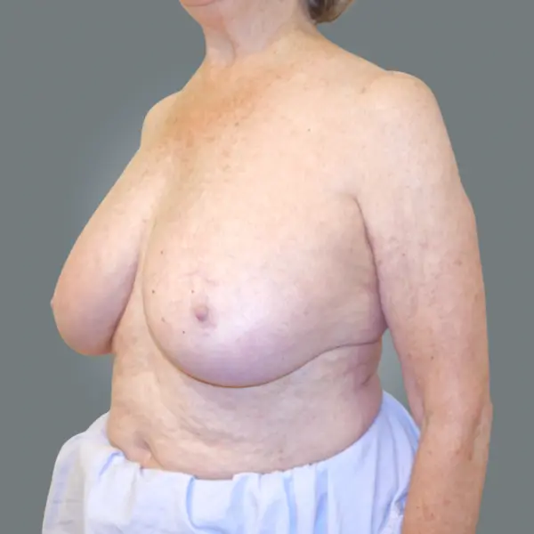 Before breast implant removal right oblique view
