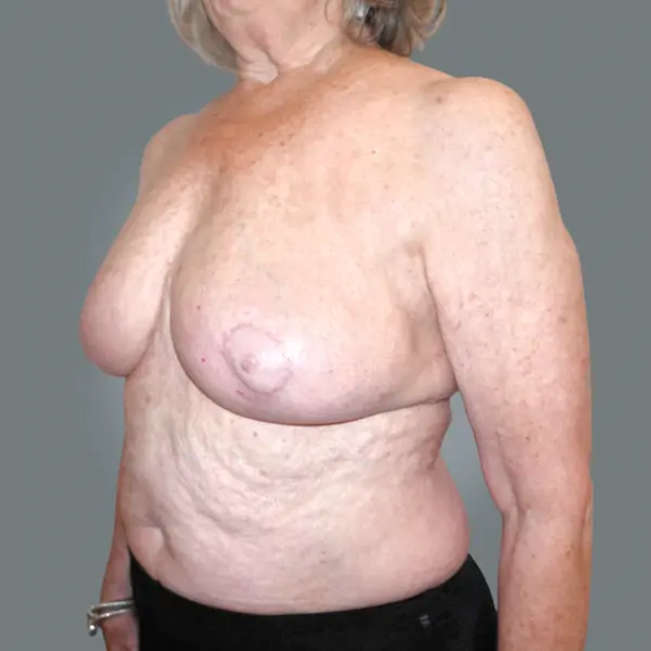After breast implant removal right oblique view