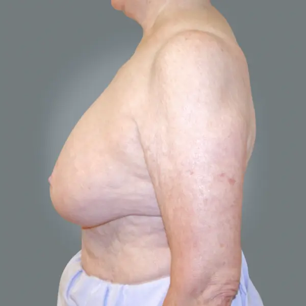 Before breast implant removal right side view