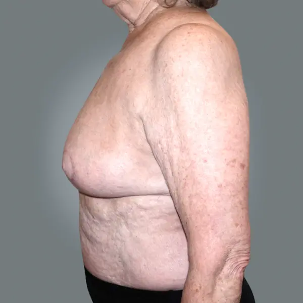 After breast implant removal right side view
