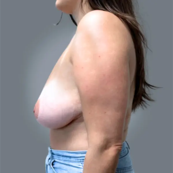 Before Secondary breast reduction right side view