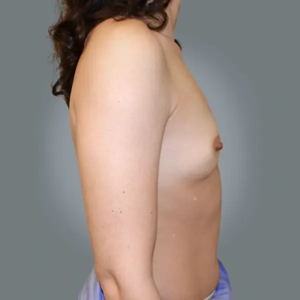 Before breast augmentation left side view