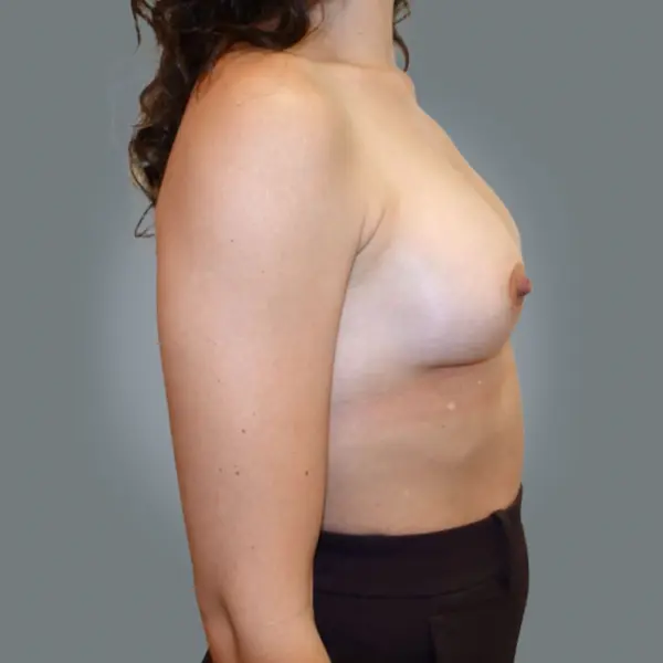 After breast augmentation left side view