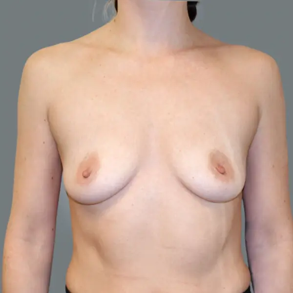 Before breast augmentation front view