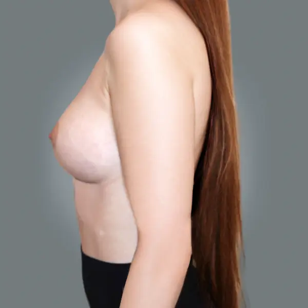After breast augmentation right side view