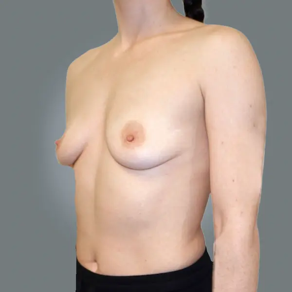 Before breast augmentation right side view