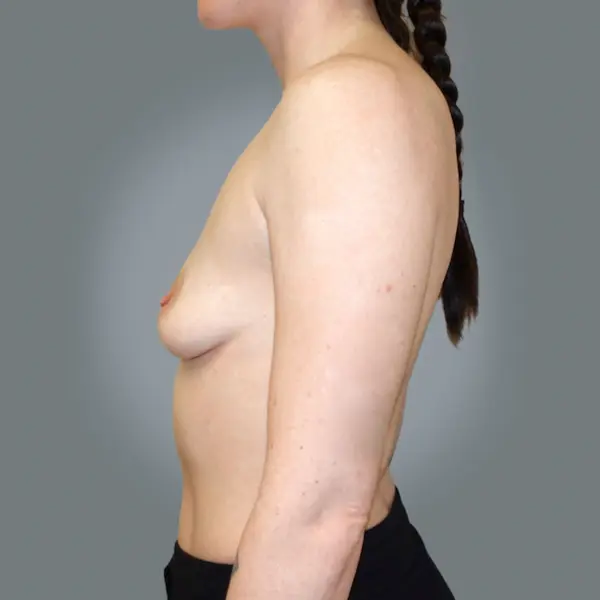 Before breast augmentation left side view