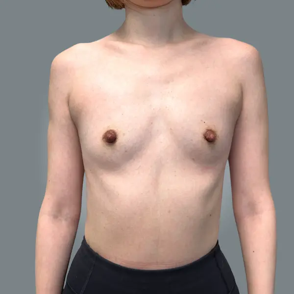 Before breast augmentation front view