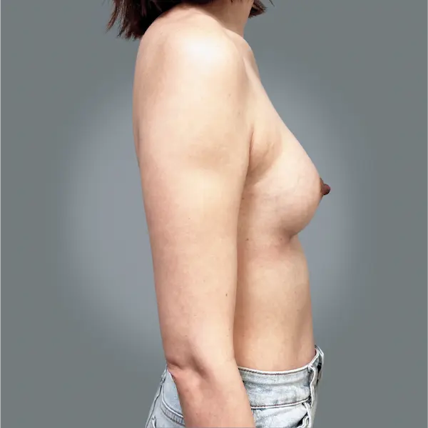 After breast augmentation left side view