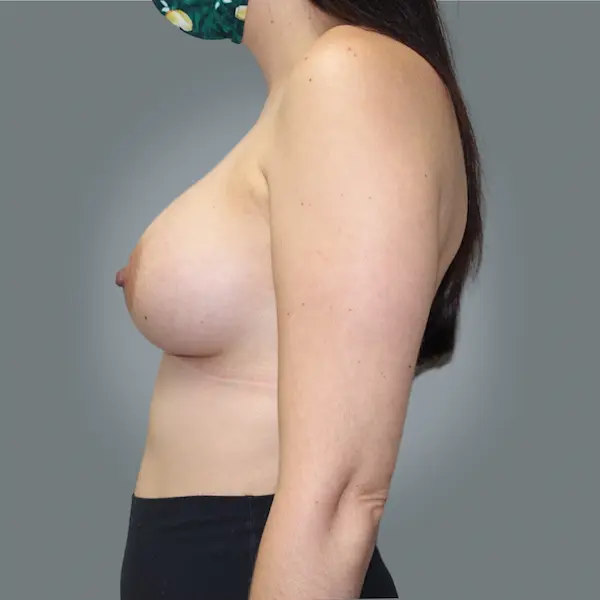 After breast augmentation right oblique view
