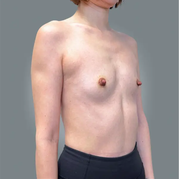 Before breast augmentation left oblique view