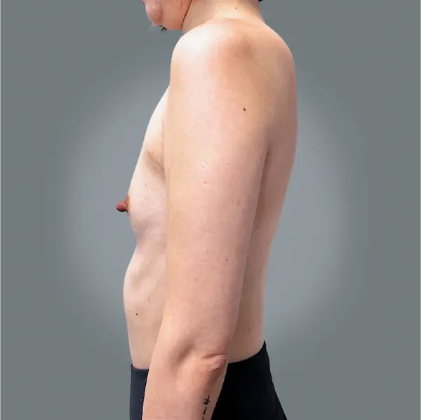 Before breast augmentation right side view
