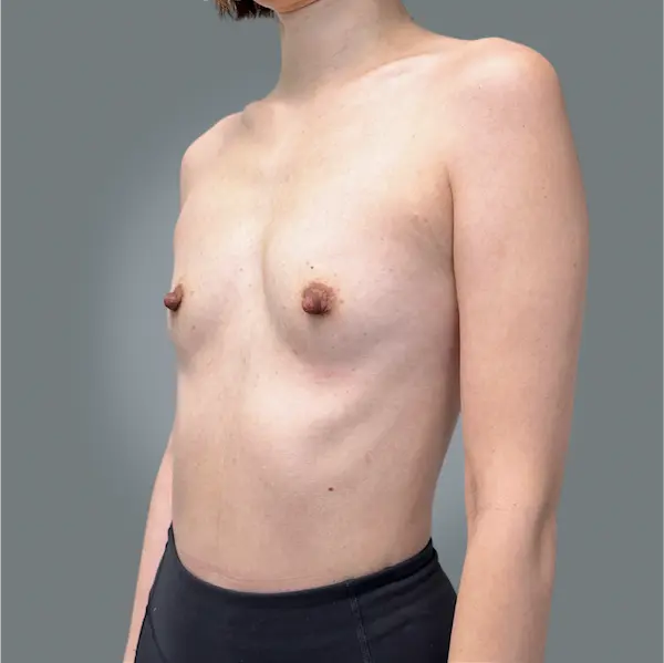 Before breast augmentation right oblique view