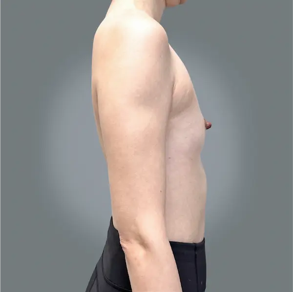 Before breast augmentation left side view