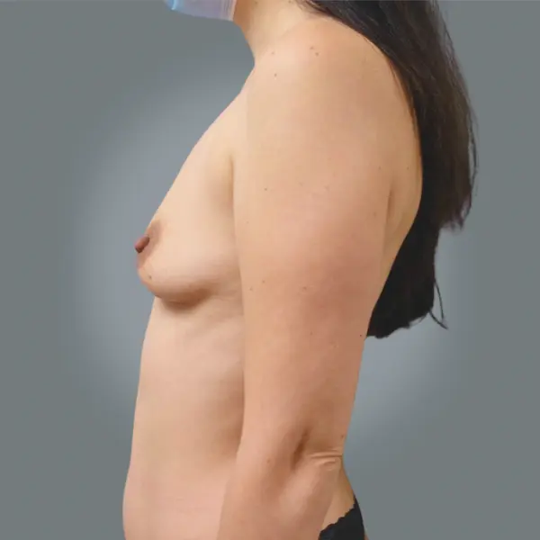 Before breast augmentation right oblique view