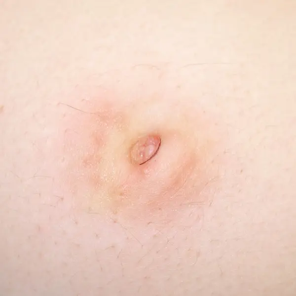 Before inverted nipple reduction