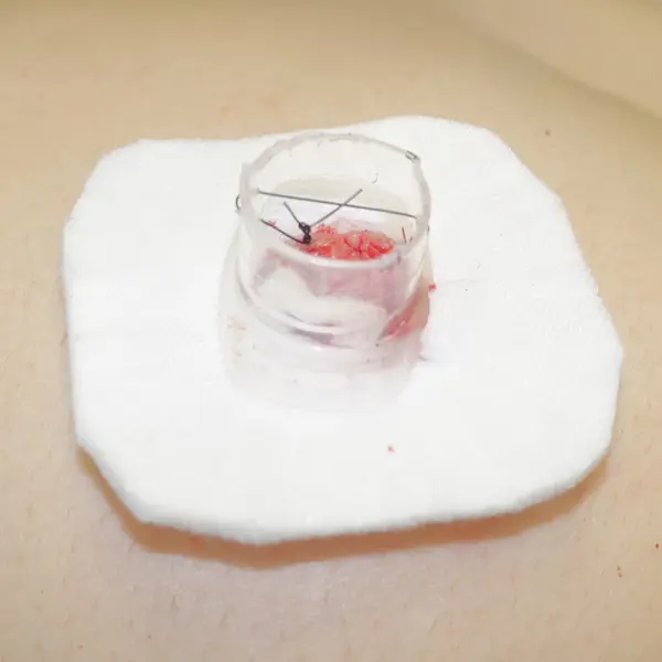 Inverted nipple reduction procedure