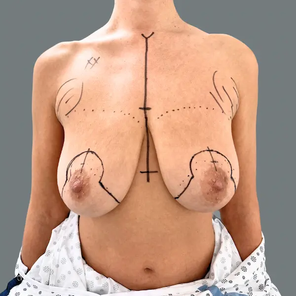Before breast lift front view
