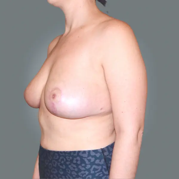 After Breast Lift with mastopexy right side view