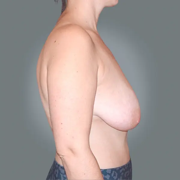 Before Breast Lift with mastopexy left side view
