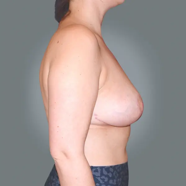 After Breast Lift with mastopexy left side view