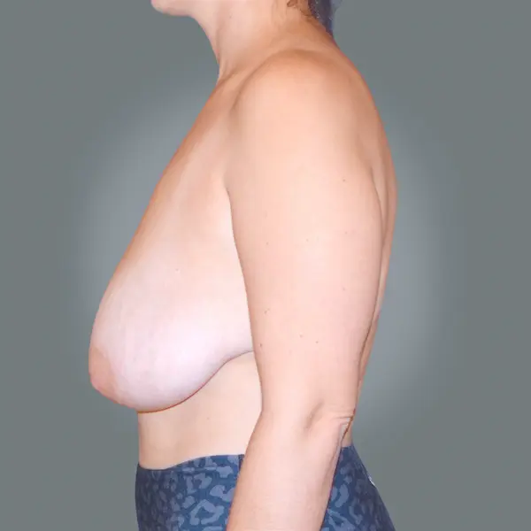 Before Breast Lift with mastopexy right side view
