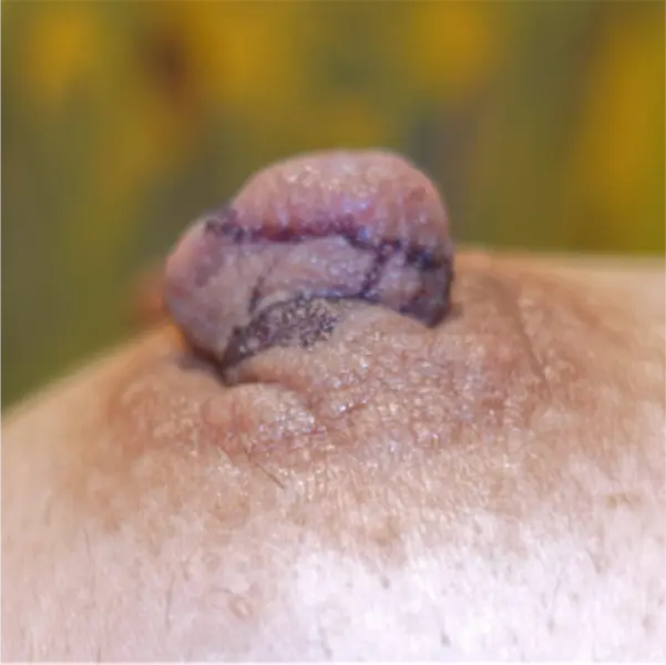 Surgical markings left side nipple reduction