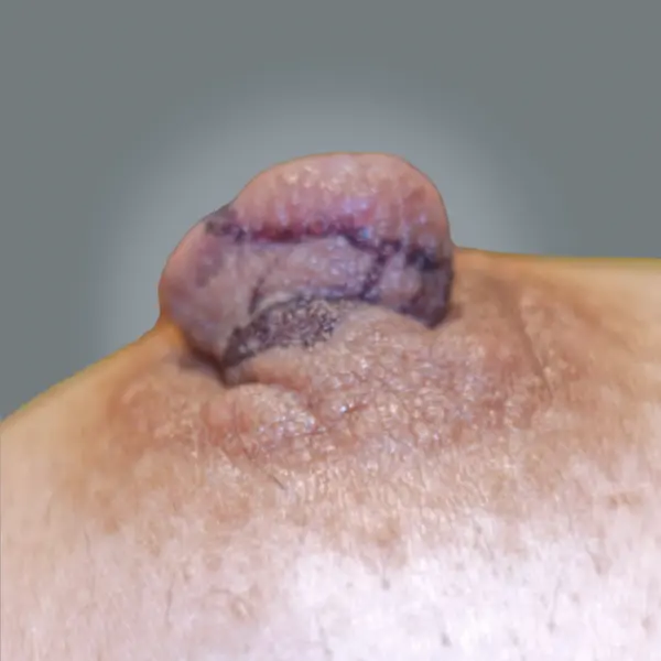 Surgical Markings left side nipple reduction