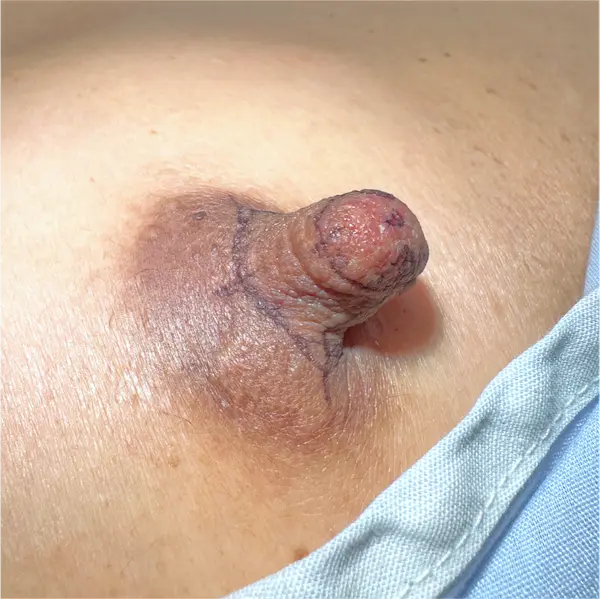 Before left side view nipple reduction