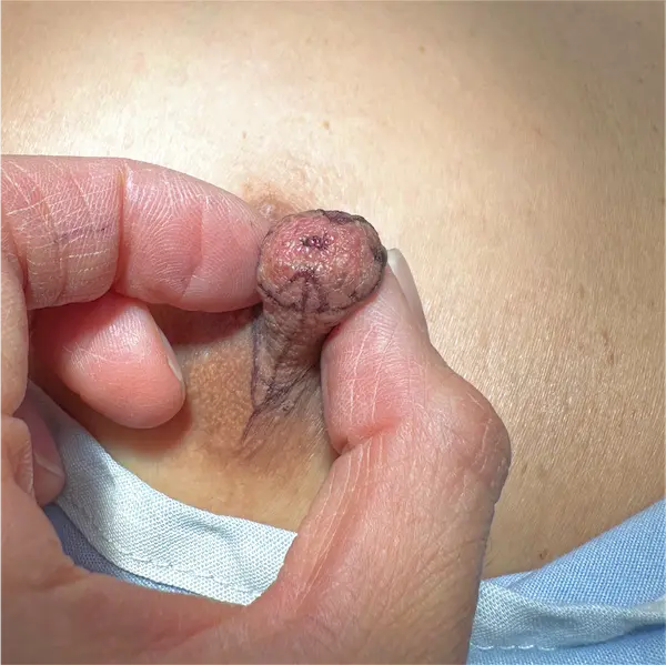 Before front view nipple reduction