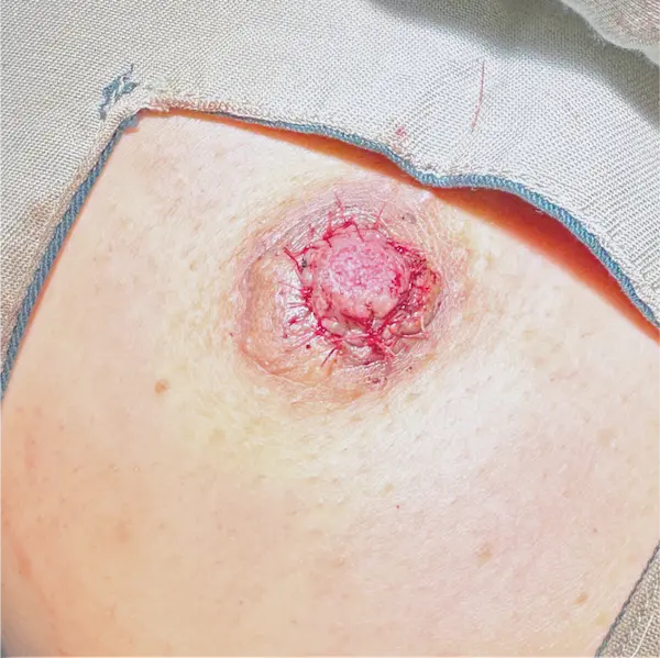 Before front view nipple reduction