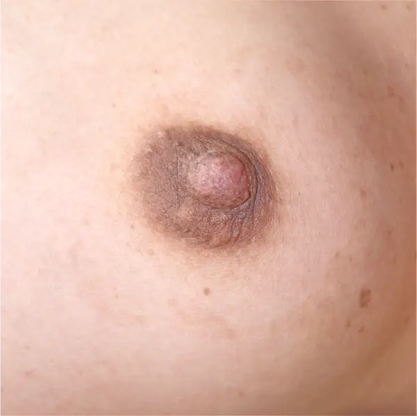 After 3 months nipple reduction