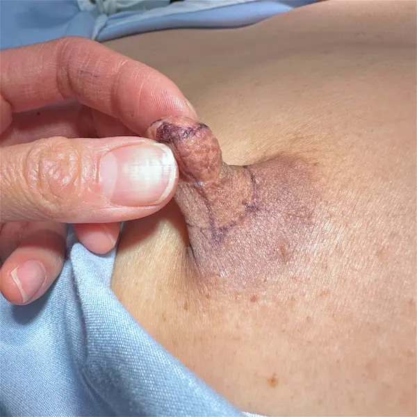Before left side nipple reduction