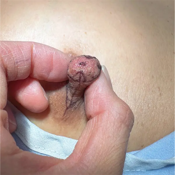Before left side nipple reduction