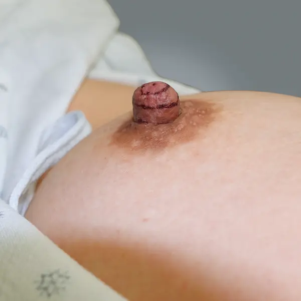 Before nipple reduction left side