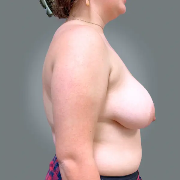 Before breast reduction left side view