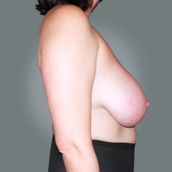Before breast reduction left side view